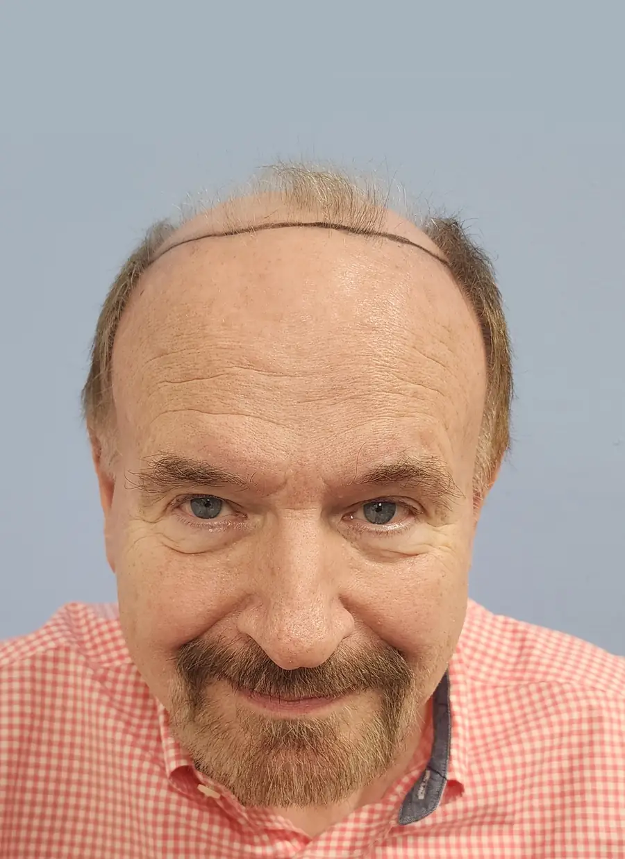 Before FUE (NeoGraft), 2,752 grafts