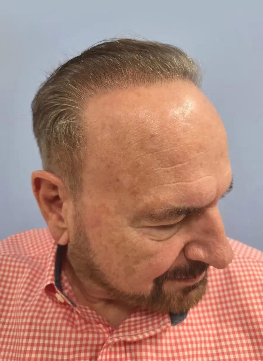 After NeoGraft FUE, 2,752 grafts