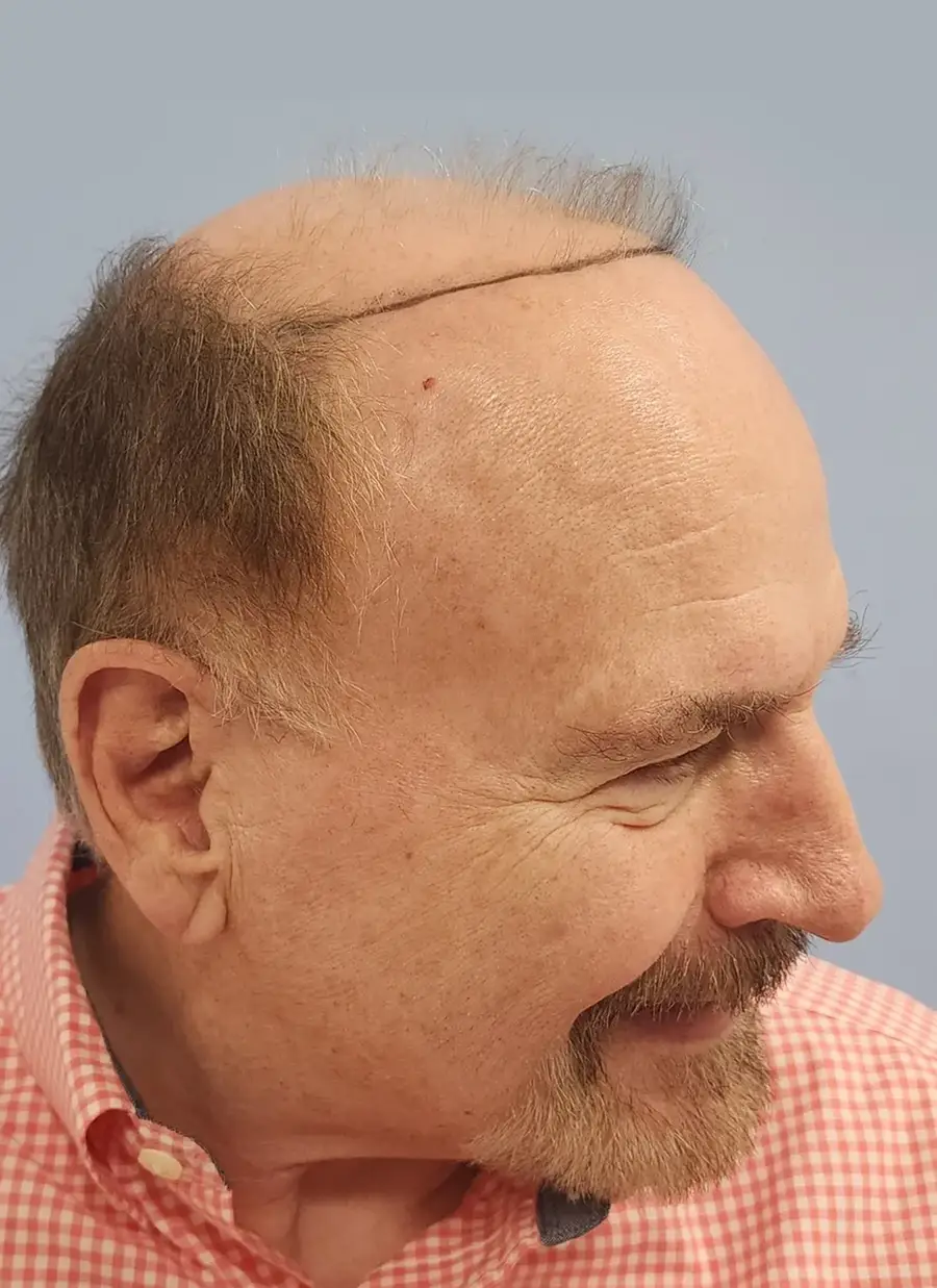 Before NeoGraft FUE, 2,752 grafts
