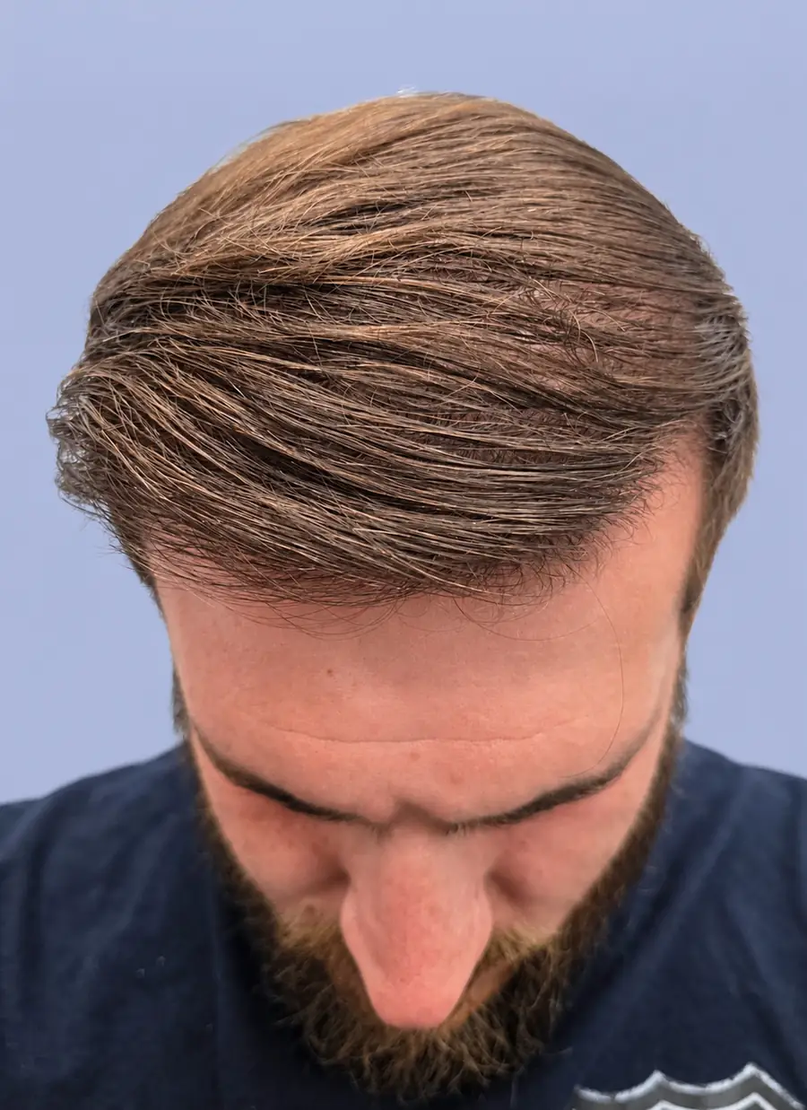 After hair transplant — 3,019 grafts · 31 y/o man