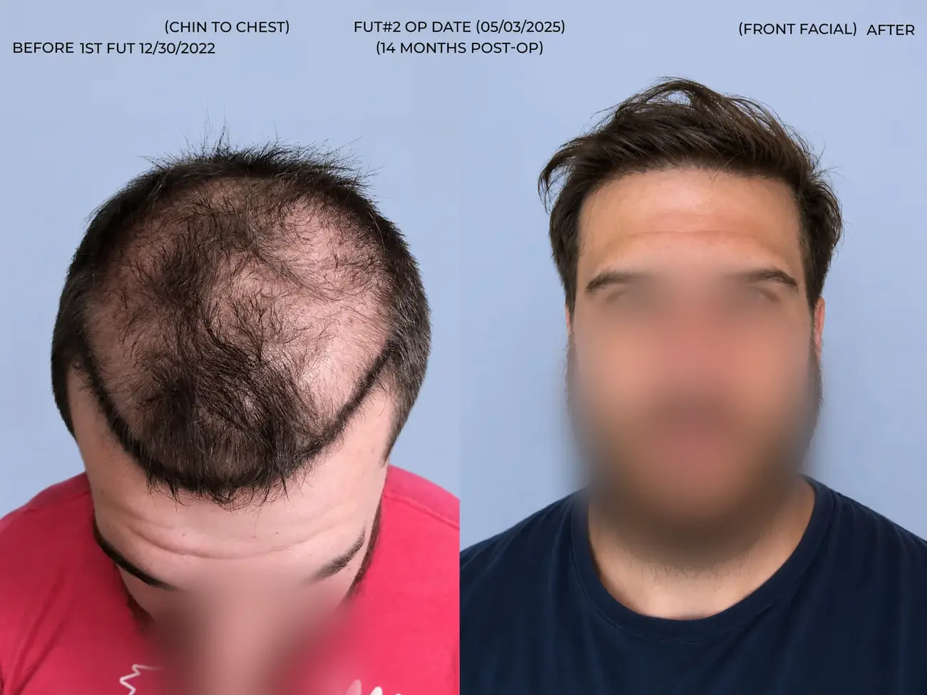 Front facial view before and after FUT (strip), two procedures, 3,019 grafts, 31 year old man