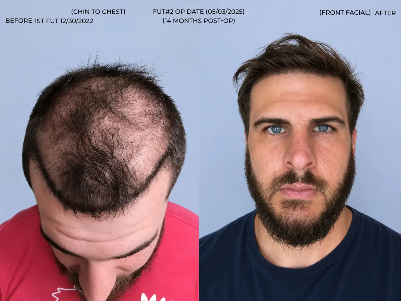 Front facial view before and after FUT (strip), two procedures, 3,019 grafts, 31 year old man