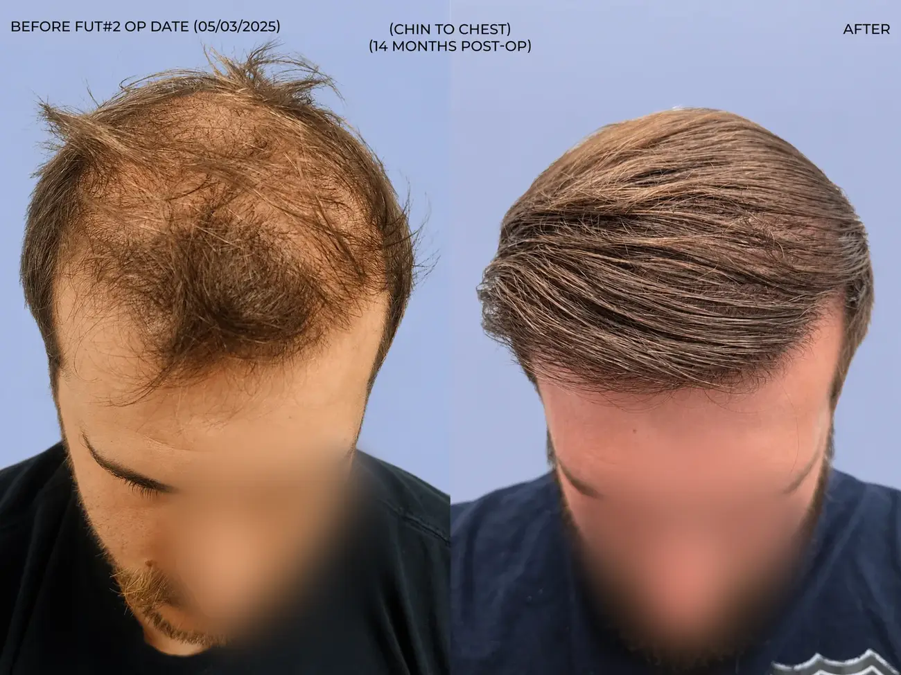 Chin to chest view before and after FUT (strip), two procedures, 3,019 grafts, 31 year old man