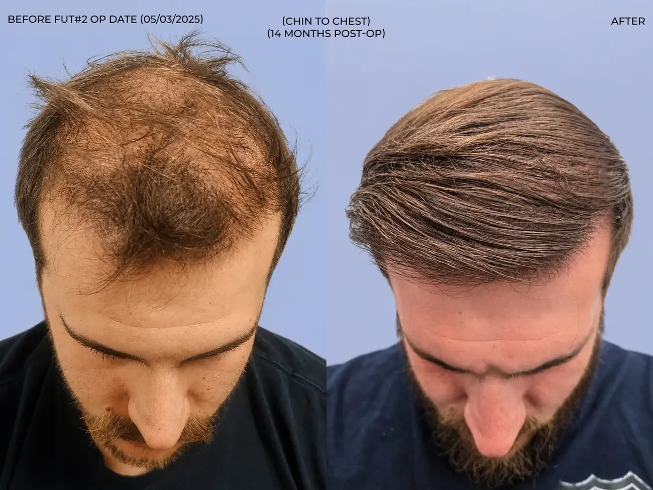 Chin to chest view before and after FUT (strip), two procedures, 3,019 grafts, 31 year old man