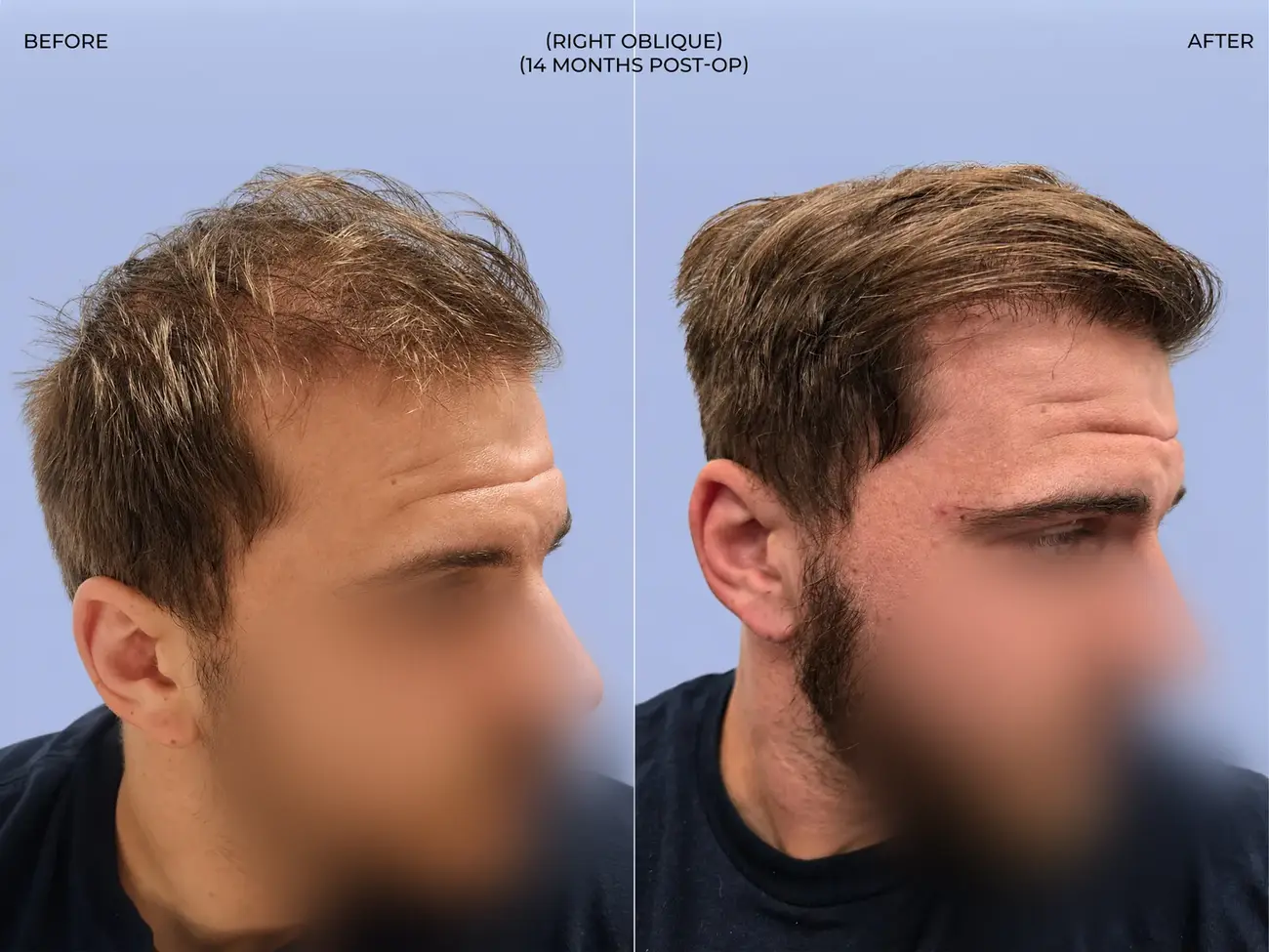 Right oblique view before and after FUT (strip), two procedures, 3,019 grafts, 31 year old man