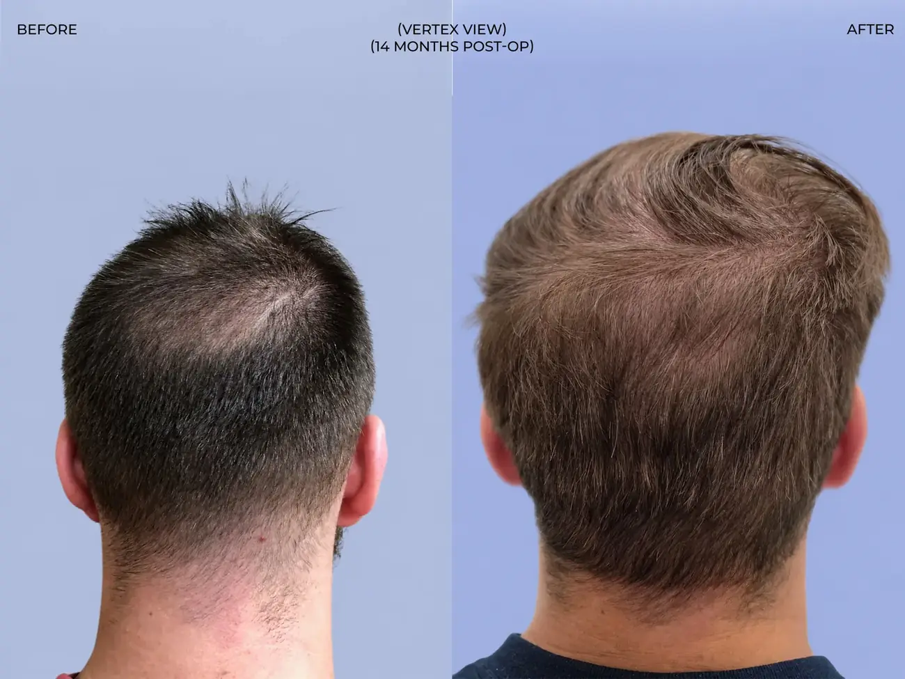Vertex (crown) view before and after FUT (strip), two procedures, 3,019 grafts, 31 year old man