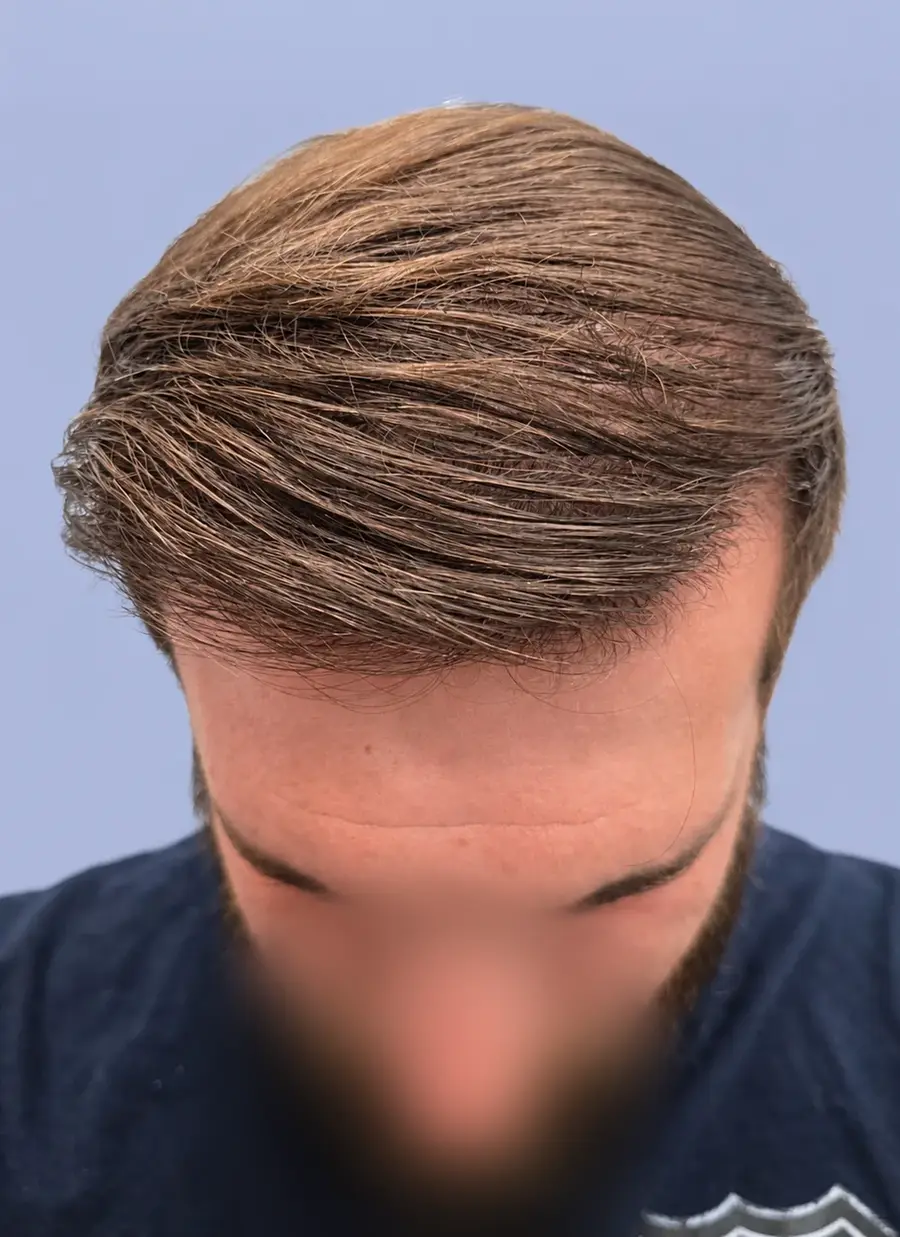 After FUT (strip), two procedures, 3,019 grafts
